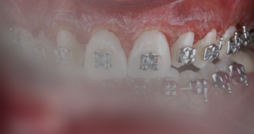 Gingivectomía